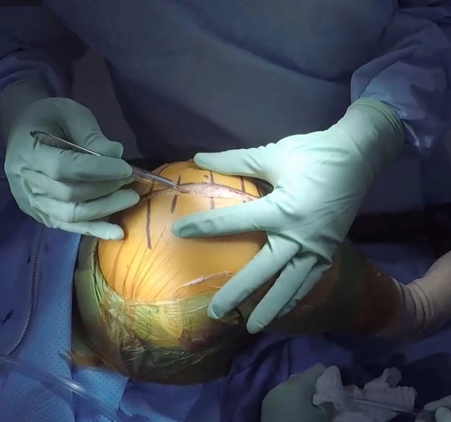 Hip-Knee-Replacement