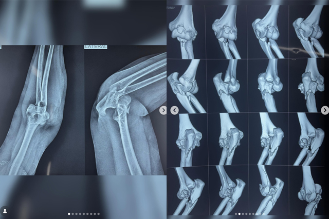 Terrible-Triad-of-Elbow-Causes-Symptoms-Treatment