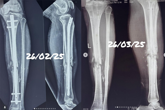 Masquelet-Technique-for-Infected-Bone-Fracture-Recovery-Bareilly