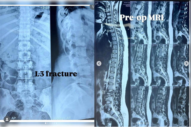 L3-Vertebral-Fracture-Recovery-Surgery-Case-Study-Bareilly