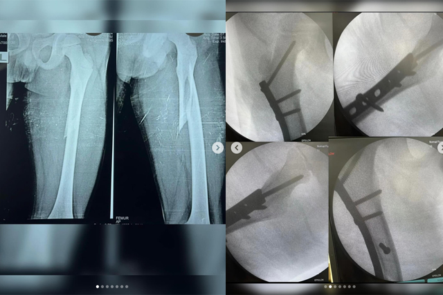 Femur-Fracture-Recovery-Healing-After-1-Year-Bareilly