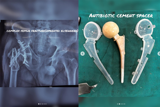 Complex-Femur-Fracture-Infection-Recovery-Case-Study-Bareilly