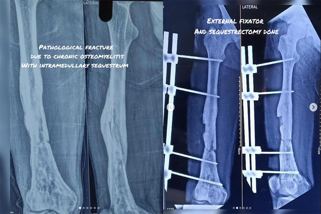 Pathological-Fracture-Chronic-Osteomyelitis-Treatment-Bareilly