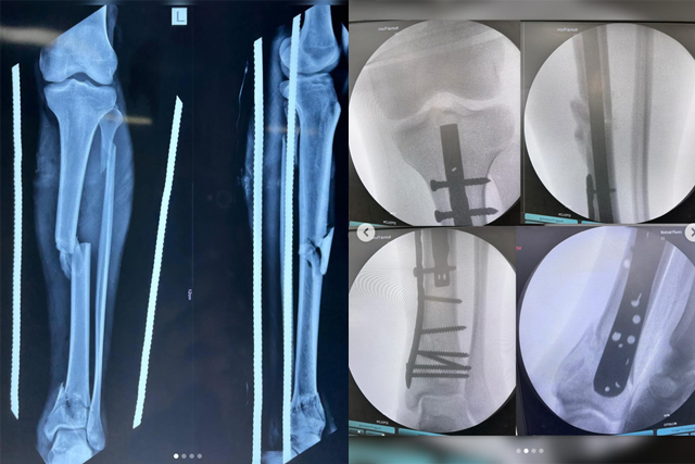 Complex-Tibia-Fracture-Surgery-Recovery-Case-Study-Bareilly