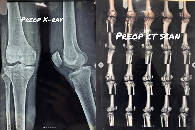 Proximal-Tibia-Fracture-Recovery-Sports-Rehabilitation-Bareilly