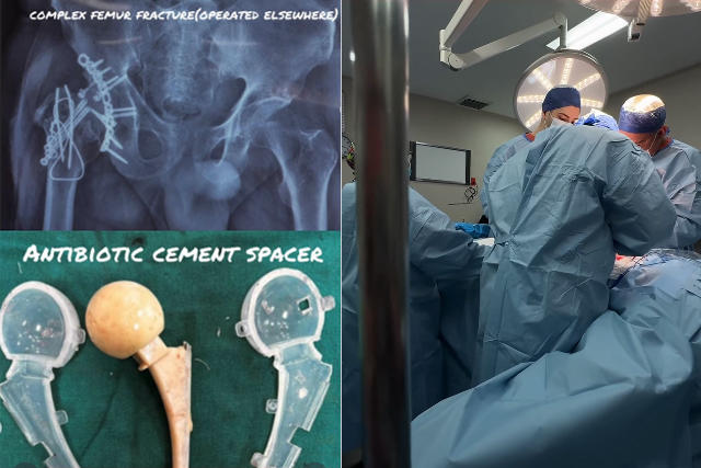 Walking-Again-After-One-Year-A-Success-Story-of-Overcoming-an-Infected-Femur-Fracture