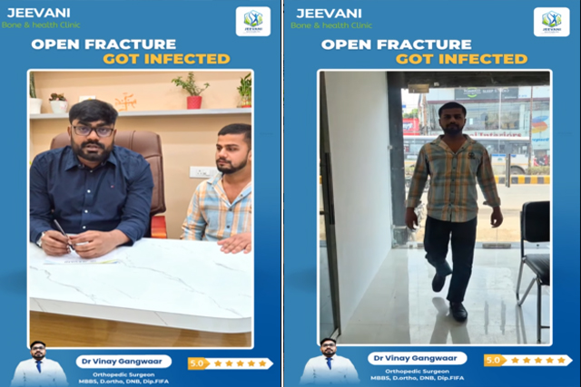 Regaining-Mobility-Expert-Orthopedic-Treatment-for-Fractures-in-Bareilly