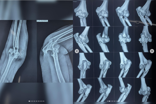 Terrible-Triad-of-Elbow-Injury-Treatment-in-Bareilly-Dr-Vinay-Gangwar