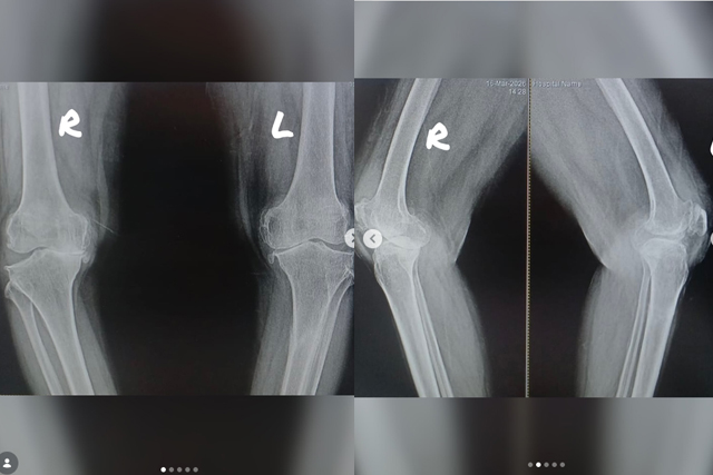 Bilateral-Knee-Replacement-Success-Story-Dr-Vinay-Gangwar-Bareilly