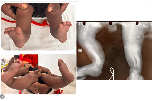 Congenital-Posteromedial-Bowing-of-Tibia-Fibula-Causes-Care