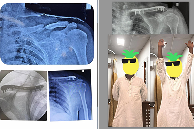 clavicle-fracture-plate-fixation-thumbnail