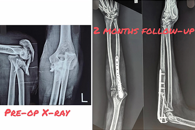 complex-elbow-fracture-recovery-thumbnail