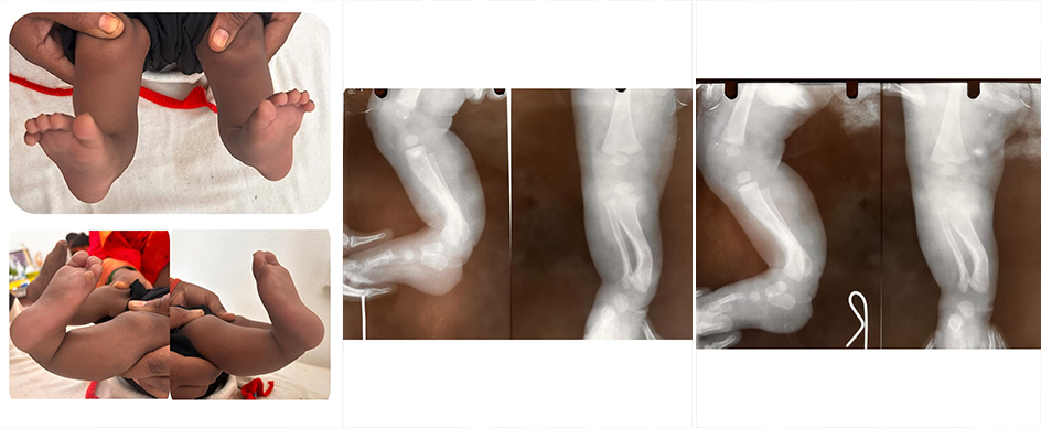 congenital-posteromedial-bowing-of-tibia-and-fibula