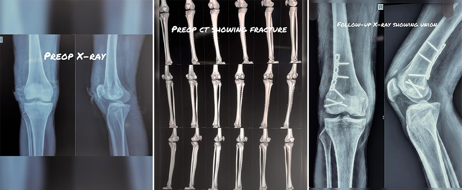 lateral-condyle-Hoffas-fracture