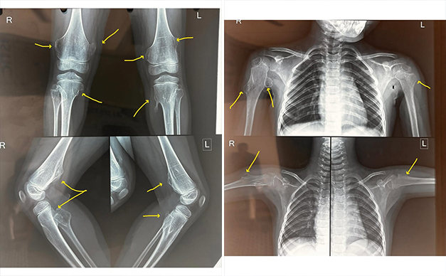 multipleh-hereditary-exostosis-MHE