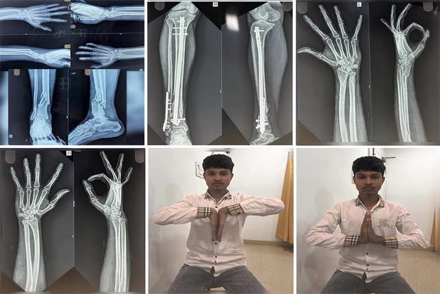 staged-orthopedic-fixation-thumbnail
