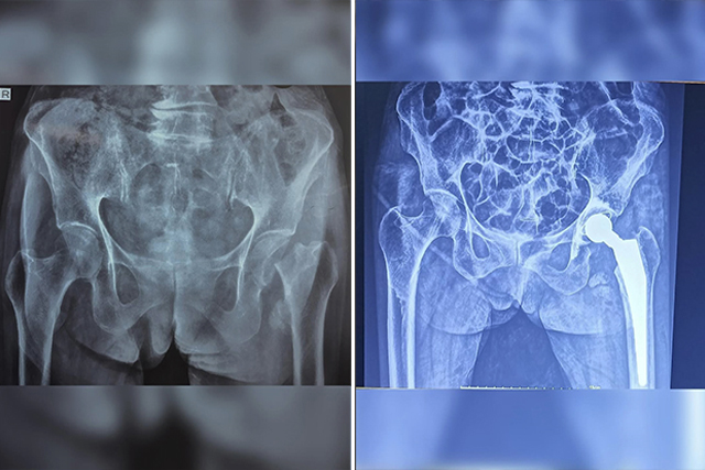 total-hip-replacement-thumbnail