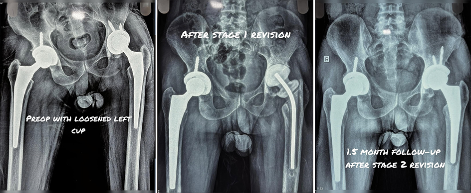 two-stage-revision-hip-replacement